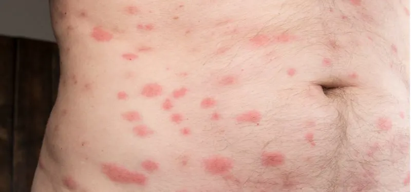 Bed bug bites picture showing a number of red spots on the front of someone's body